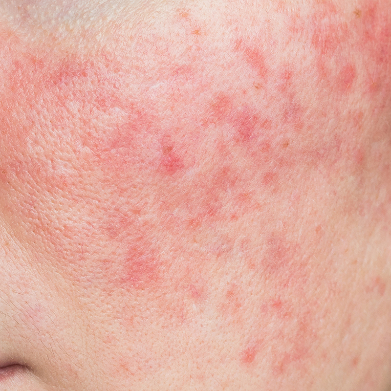 Facial redness and flushing, indicative of rosacea