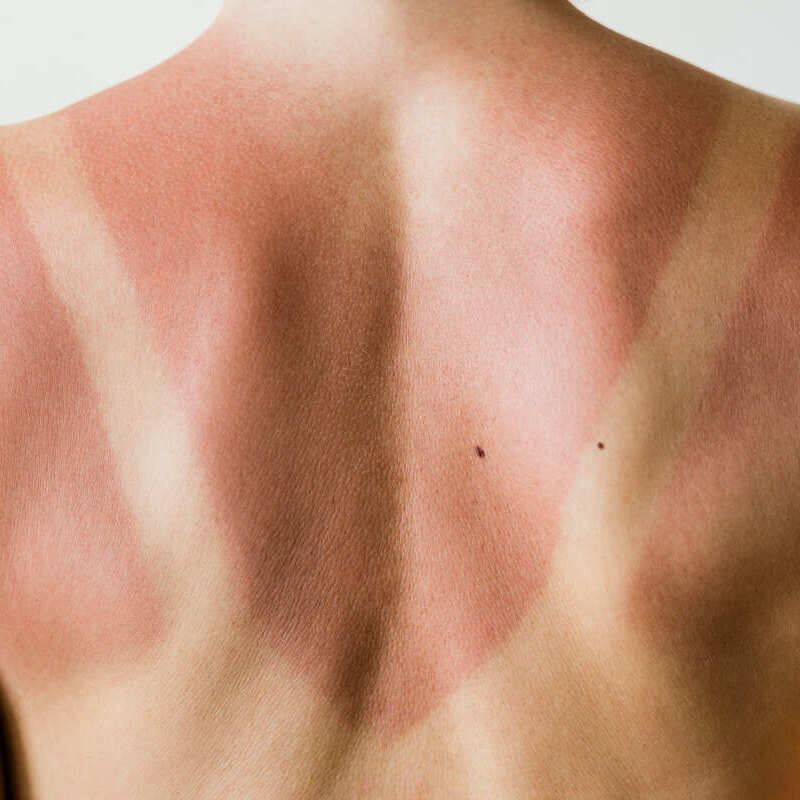 skin and sun tanlines on back