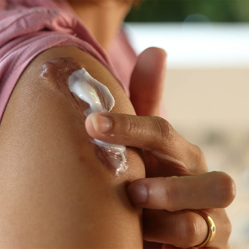 weakened and irritated skin applying cream to scar