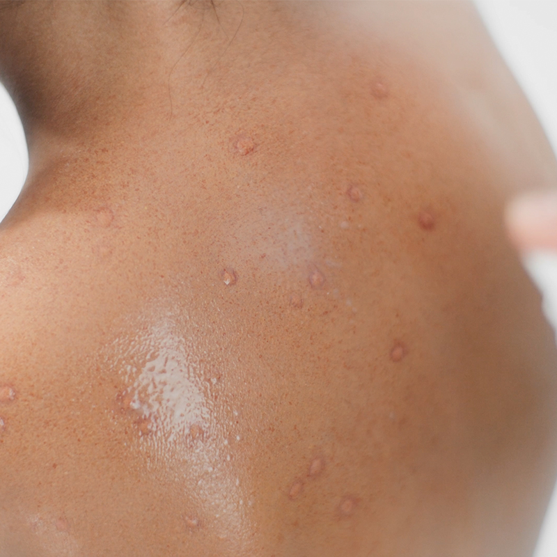 Woman's back with chickenpox scarring