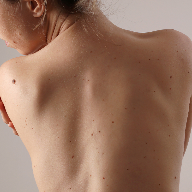 Unscarred woman's back