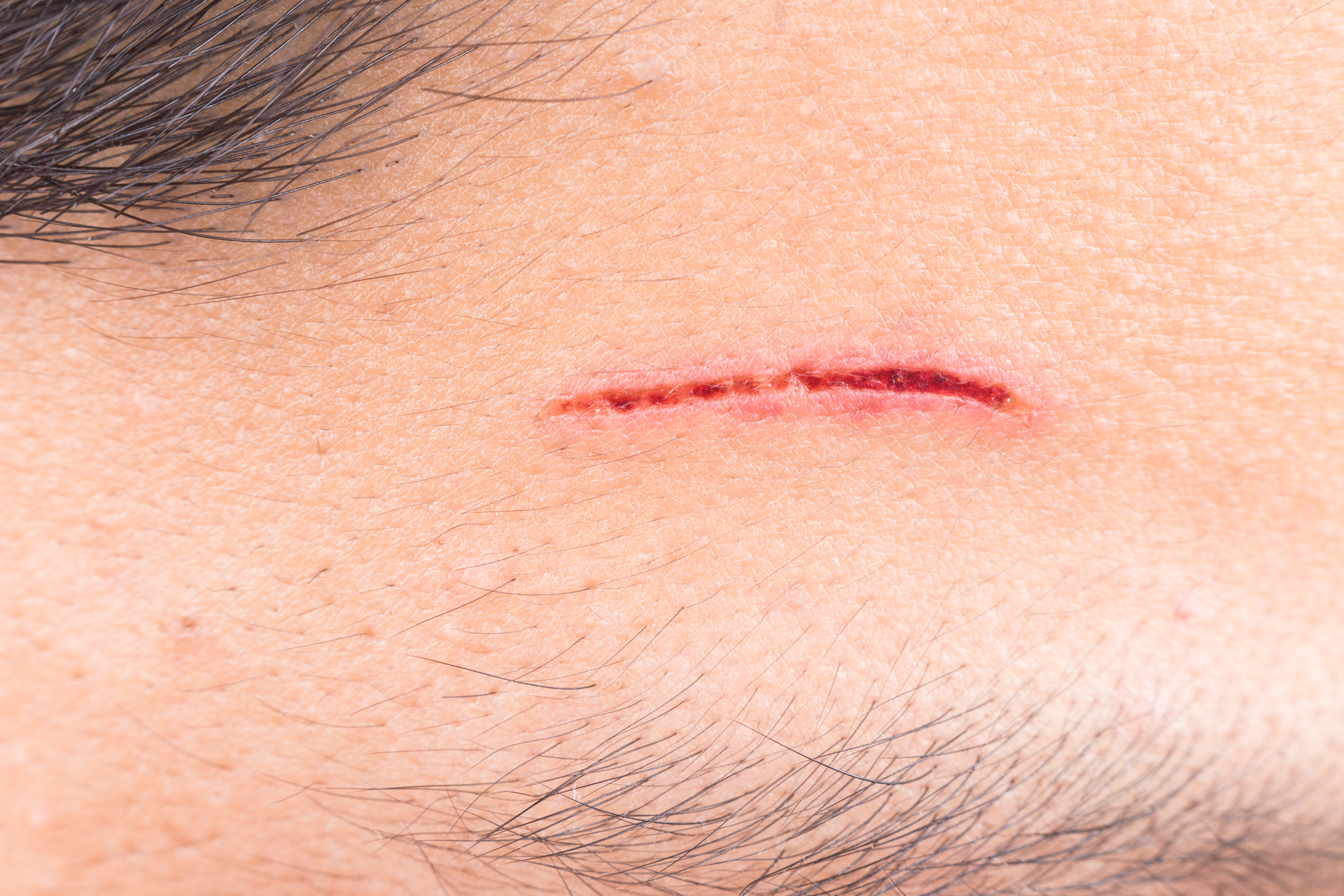 Inflammatory scar