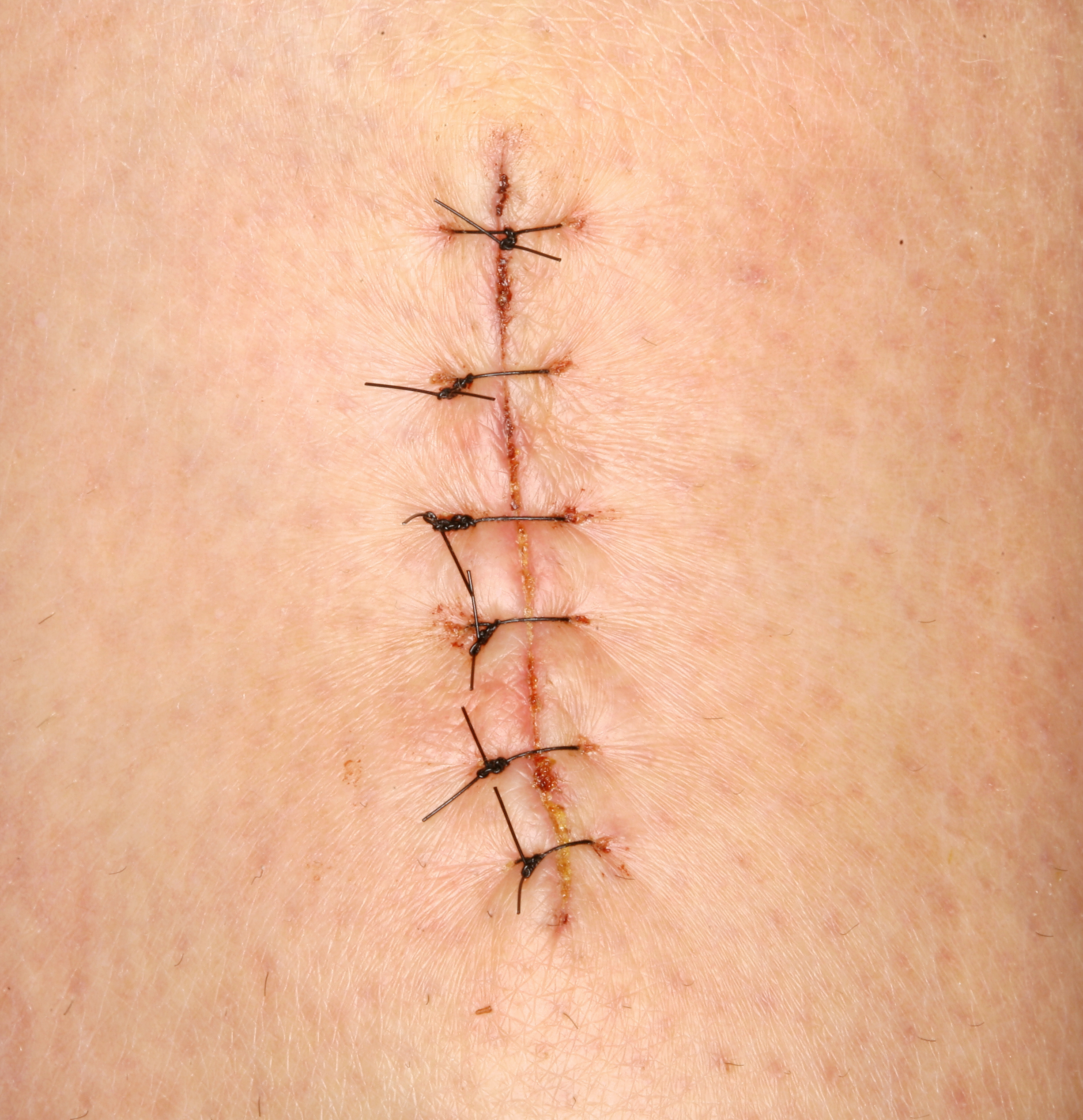 Structures scar