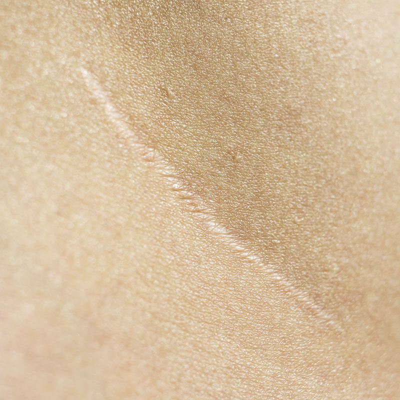 Scars massage